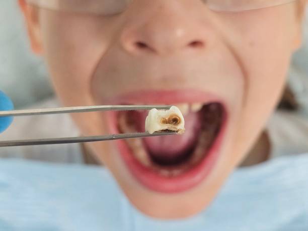 Best Emergency Dental Care for Broken or Chipped Teeth in Middletown, MD